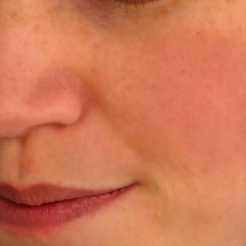 Image with lines under eyes reduced, line around the corner of the mouth has been reduced, spot under nose removed, freckles reduced, shadow under eye reduced, lips enhanced and skin softened.